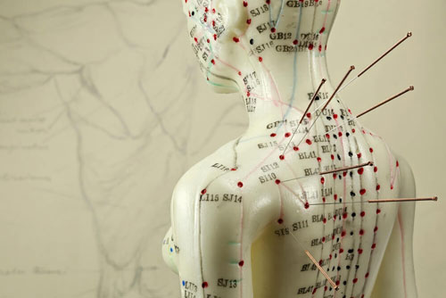 Acupuntura